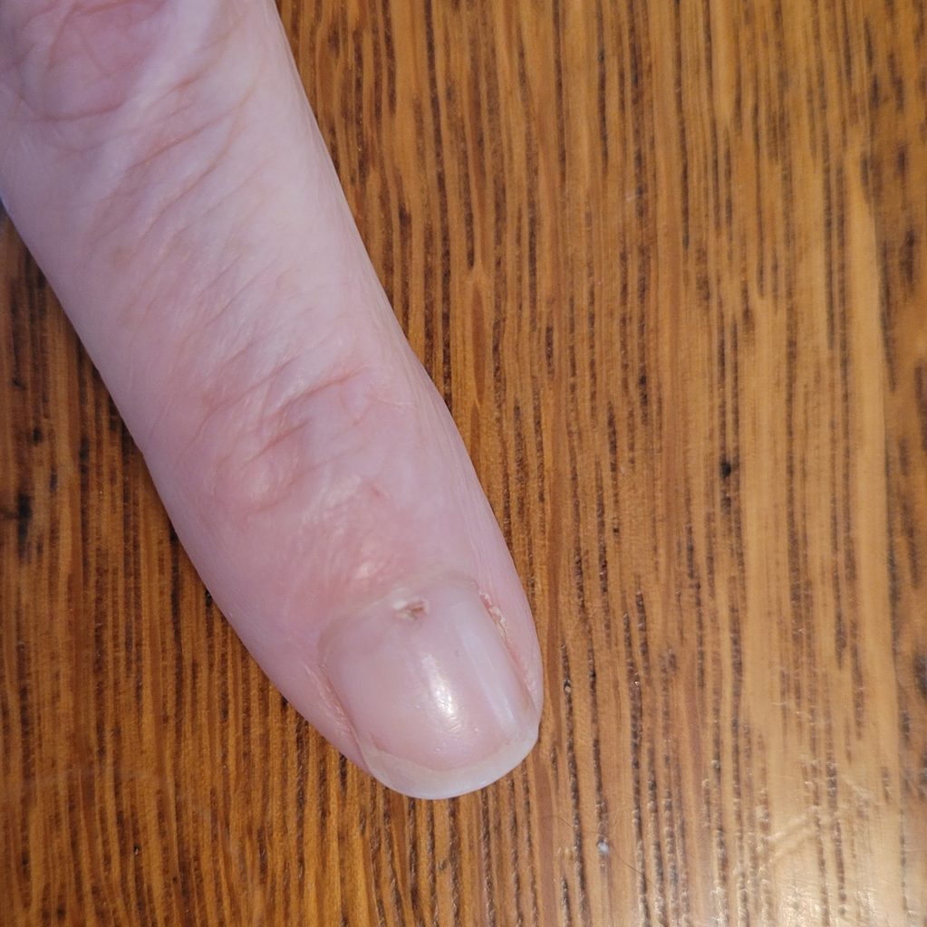 Closeup of a finger nail showing a healing needle puncture